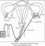 Zift Procedure Living Zygote Sperm Infertility Transvaginal Reproductive Retrieval Fertilization Embryos Donor Ivf Healthjade sketch template