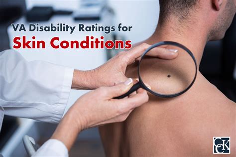 Va Disability Ratings For Skin Conditions Cck Law