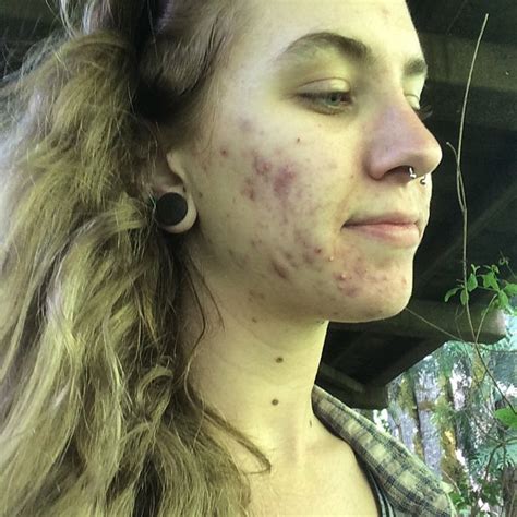 girls are sharing their acne struggles on insta to show you don t have to be ashamed of your skin