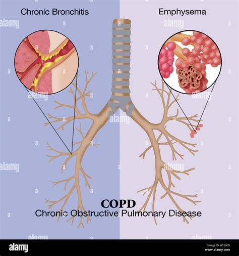 illustration  chronic obstructive pulmonary disease copd  common