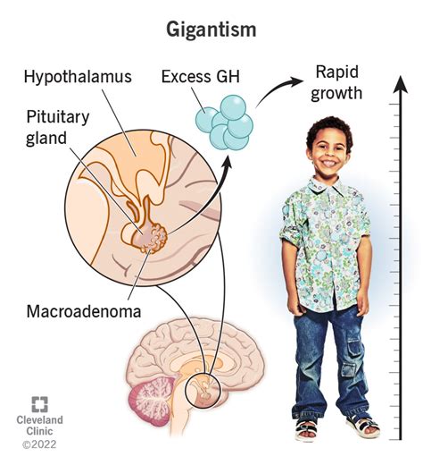 gigantism     symptoms treatment flipboard