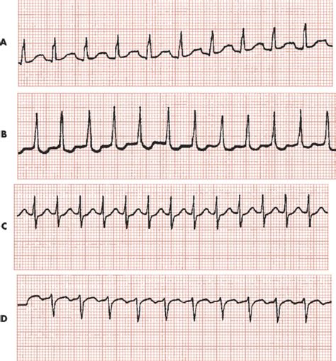 Bradycardias And Tachycardias Cardiac Rhythm Disturbances Clinical