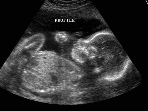 Sex of baby ultrasounds