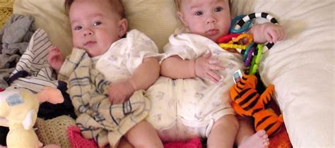 Conjoined Twins Separated In Risky Surgery At 7 Months Old Now Thriving
