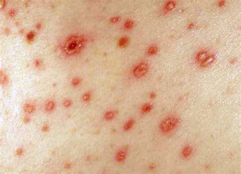 hiv rash pictures images symptoms treatment