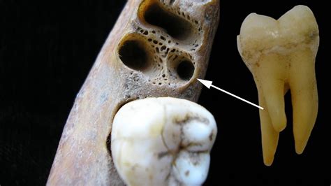 rooted molars  rare dental trait lives