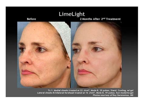 ipl intense pulse lightlimelight facial beautiful skin rsvp med