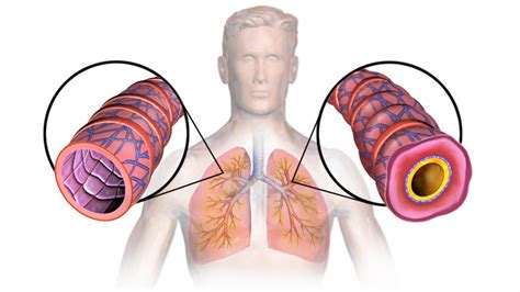 asma bronquial sintomas comunes causas remedios  tratamientos