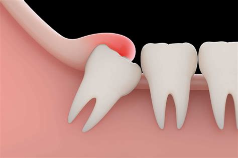 importance  wisdom teeth extraction  good oral health
