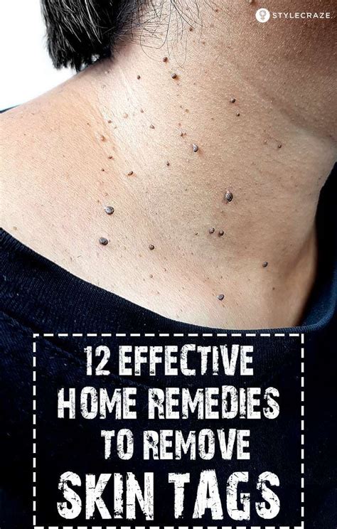 how to remove skin tags fast and safely at home proven home remedies