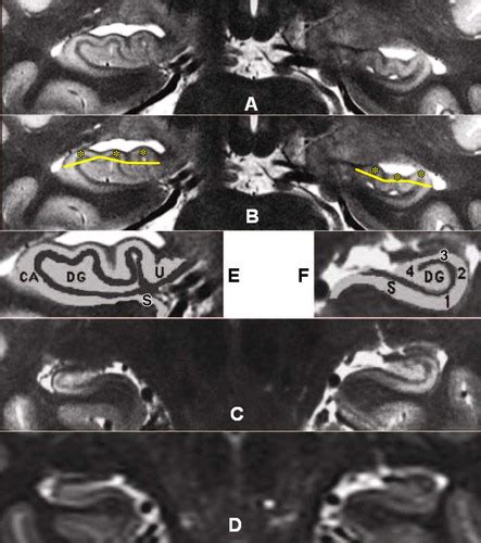 Hippocampal Sclerosis In Temporal Lobe Epilepsy Findings At 7 T