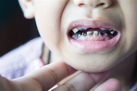 tips  prevent tooth decay  kids kakar dental group