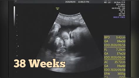 39 weeks pregnant ultrasound