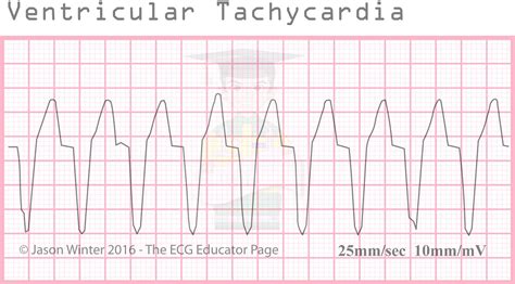 ecg educator blog ventricular rhythms