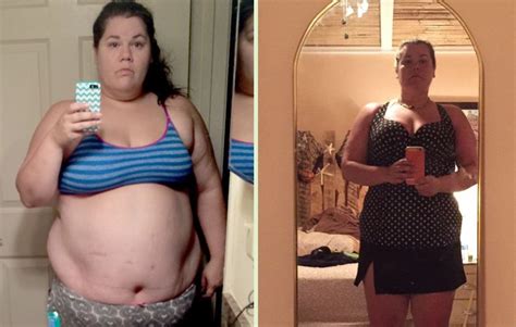 9 Things I Wish I Knew About Gastric Bypass Surgery