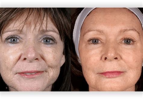 Before And After Thread Lift Procedures Thread Lift Doctor