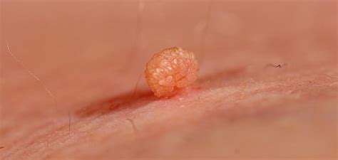 wart and skin tag removal in bangalore dr joshy s medical