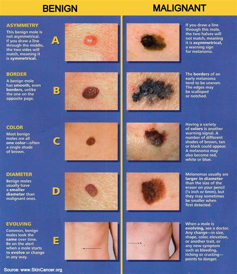 melanoma early stage melanoma skin cancer pics steve
