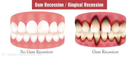 gum recession gingival recession  symptoms diagnosis