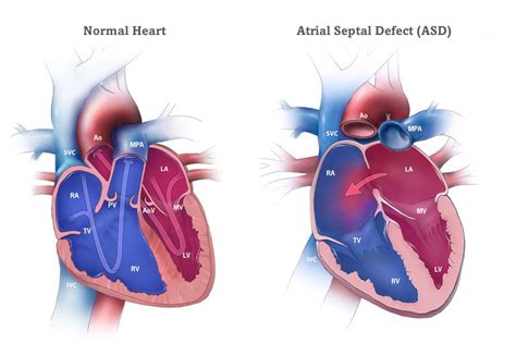 atrial septal defect acha