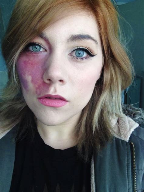 Woman Told She Was ‘undateable’ Shows Off Large Birthmark She Hid For
