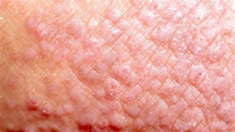 types  eczema contact dermatitis gladskin