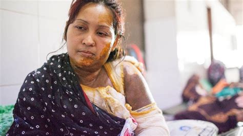 Wife Suffers Horrific Burns After Husband Throws Acid In Her Face