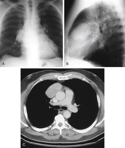 Figure Anterior Mediastinal Mass A Rare Presentation Of Tuberculosis