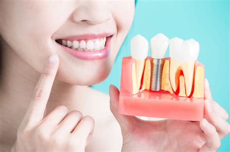 dental implants cleaning  maintenance
