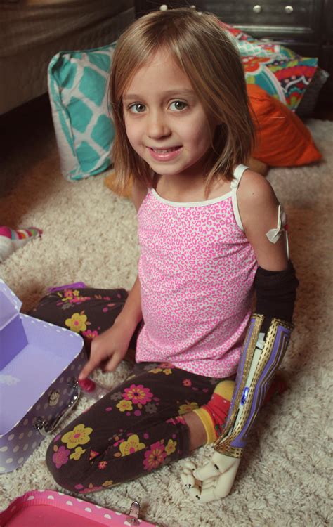 Holiday Miracle – 3d Printed Myoelectric Arm Allows Girl Free