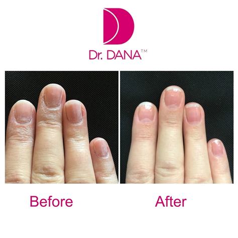 dr dana nail renewal system healthy nails beauty guide nails