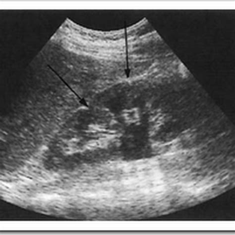 ultrasound images  normal kidneys radiology imaging