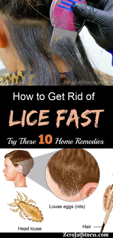 how to get rid of lice fast 10 best home remedies if you are having a