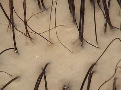 Un fenomeno fisiologico, certo, ma che può rendere la chioma sfibrata e secca. Alopecia Androgenetica Femminile â Sito ufficiale della Dr.ssa