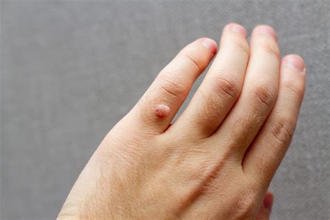 pinky wart finger wart  hand  healthcare hub