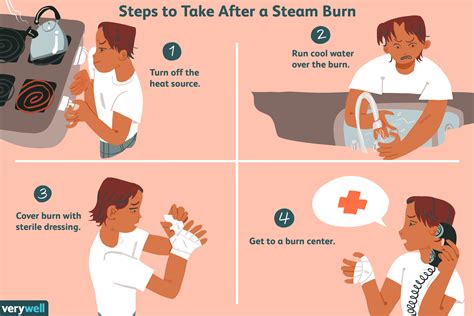 steam burns symptoms treatment  prevention