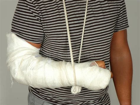 broken arm stock image image  accident cast hospital