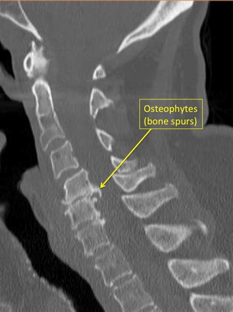 understanding bone spurs   neck area   spine