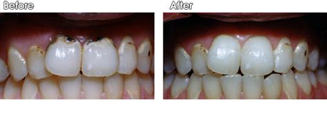 Tooth Colored Fillings Gallery Dr Jack M Hosner D D S
