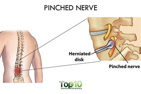 home remedies   pinched nerve top  home remedies
