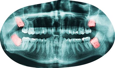wisdom tooth extraction  surgery wesmile dental care