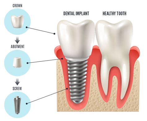 Implantes Dental Arts San Diego