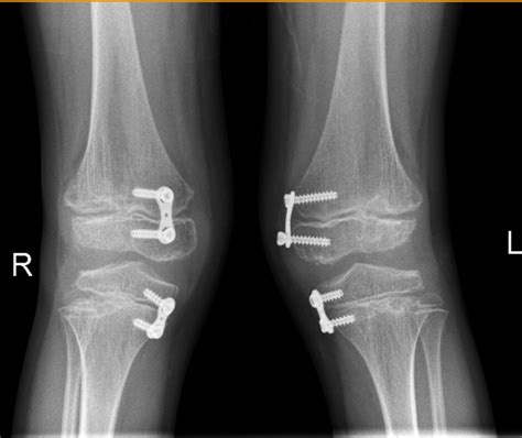 guided growth   plates  knock knees ballaratosm ballarat