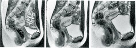 magnetic resonance imaging of male and female genitals during coitus