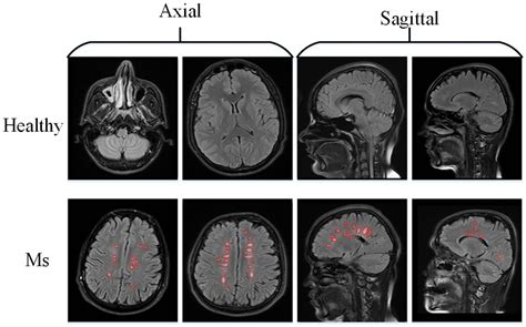 Applied Sciences Free Full Text An Accurate Multiple Sclerosis