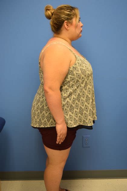 Patient 518 Gastric Sleeve Before And After Photos Houston Plastic