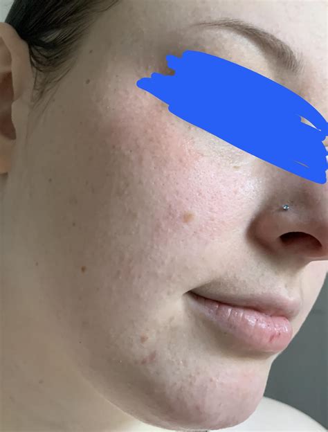 weird bumps  appearing   face  dont fade   time