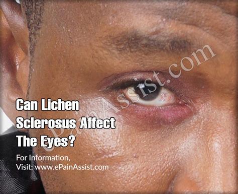 can lichen sclerosus affect the eyes