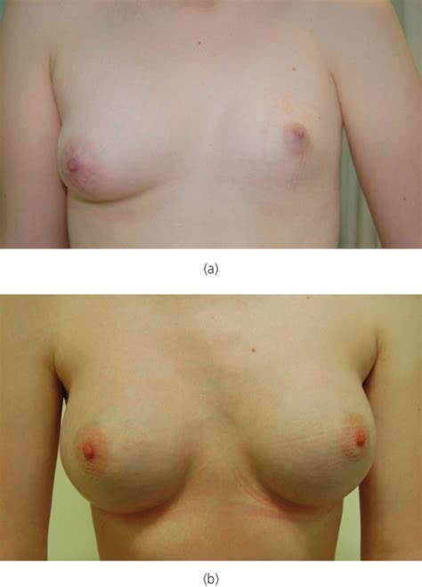 puberty budding breasts