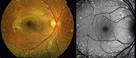 flecked retina disorders ento key